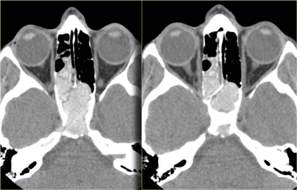 Allergic fungal sinusitis - unenhanced CT