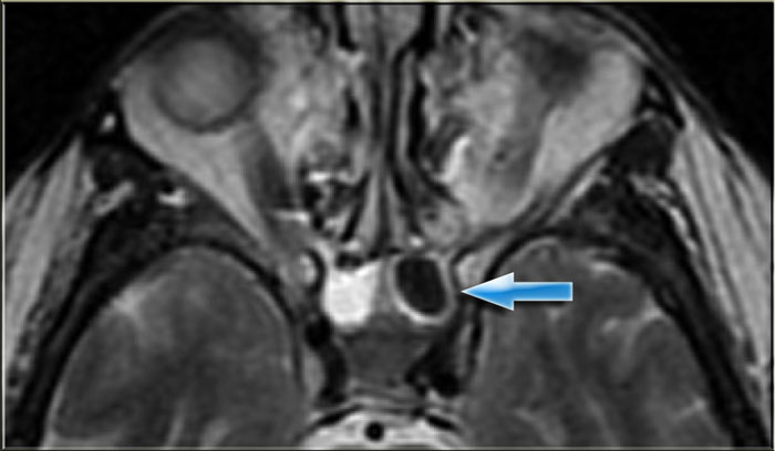 Pseudo-pneumatized sinus