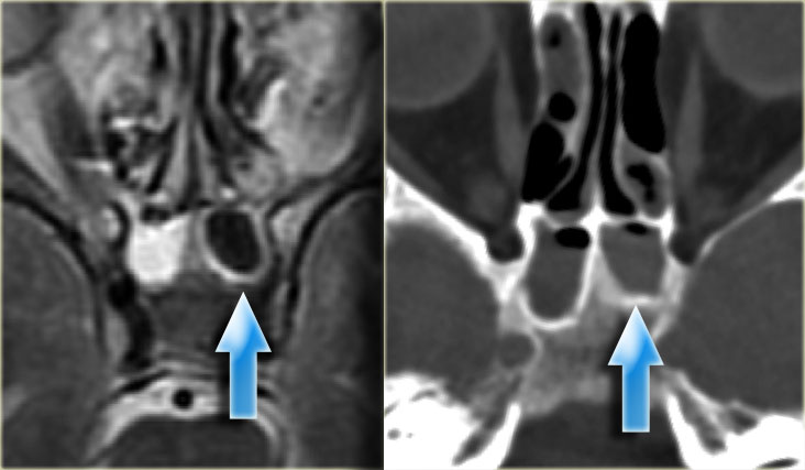 Pseudo-pneumatized sinus on MR. Beware of fungus!