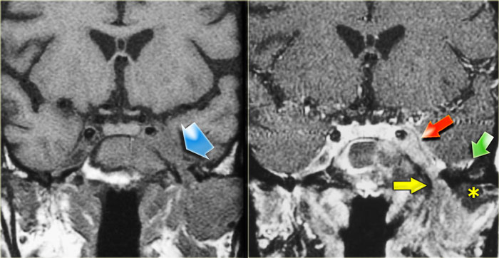 Lymphoma of sphenoid sinus and skull base