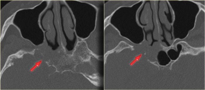 Sinonasal carcinoma