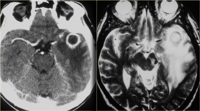 Brain abscess