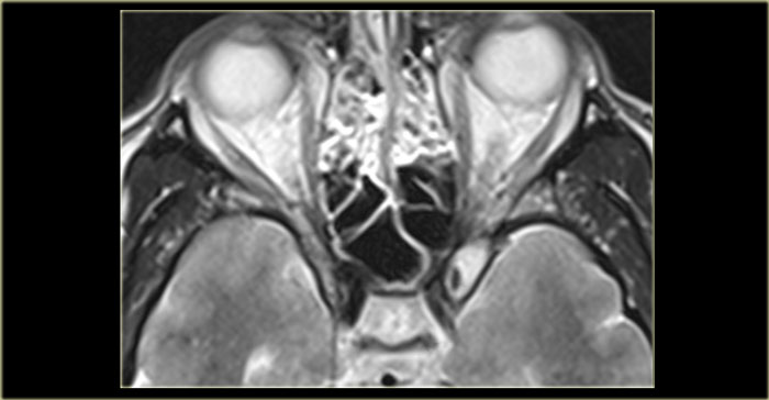 Mucocele