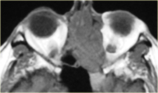 Sinonasal carcinoma