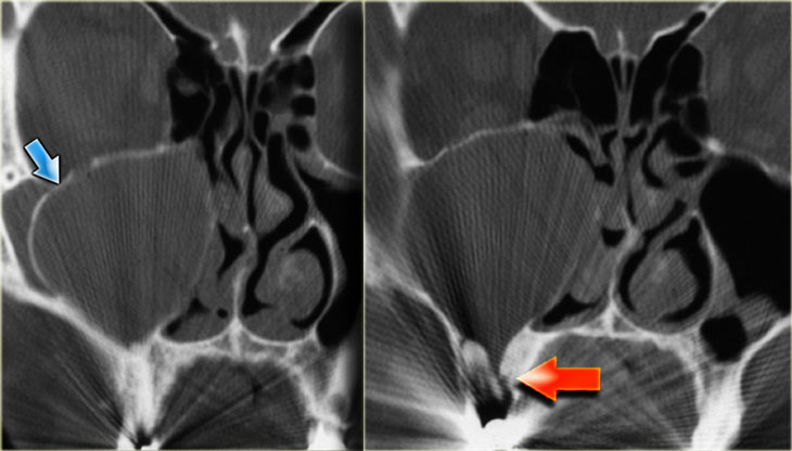 Keratocyst