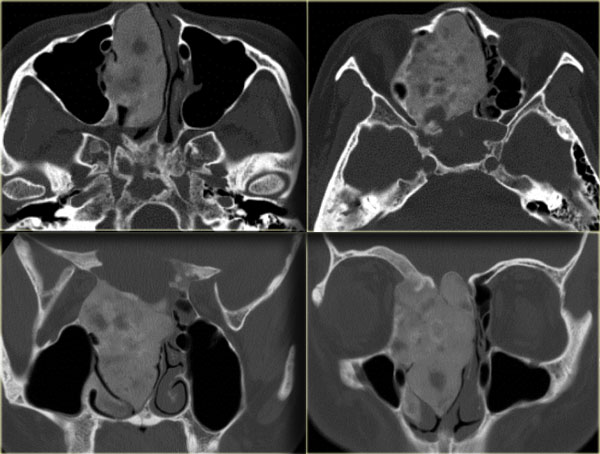 Classic fibrous dysplasia on CT