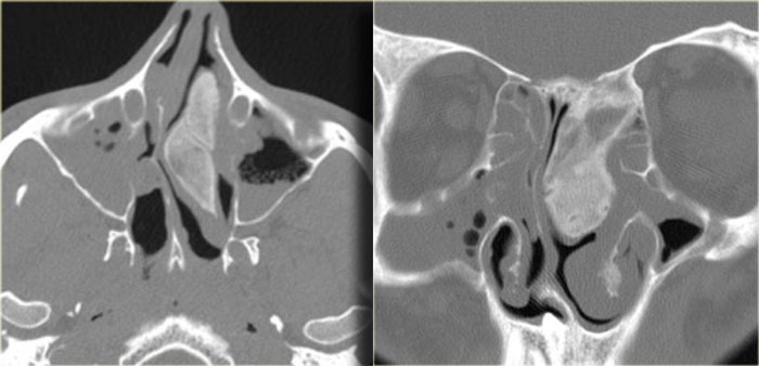 Fibrous dysplasia of the middle turbinate