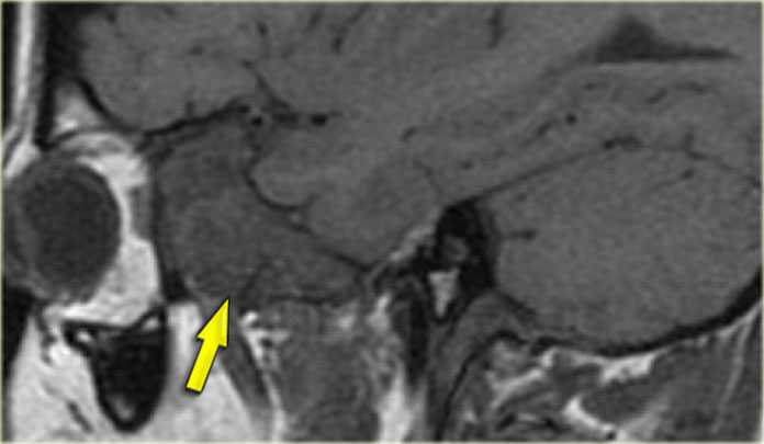 Fibrous dysplasia