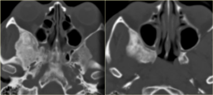 Fibrous dysplasia