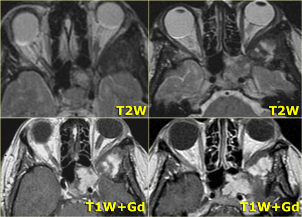 Fibrous dysplasia