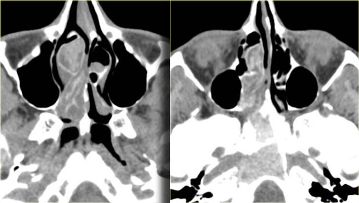 Osteitis of the middle turbinate