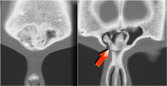 Osteoma in frontal sinus