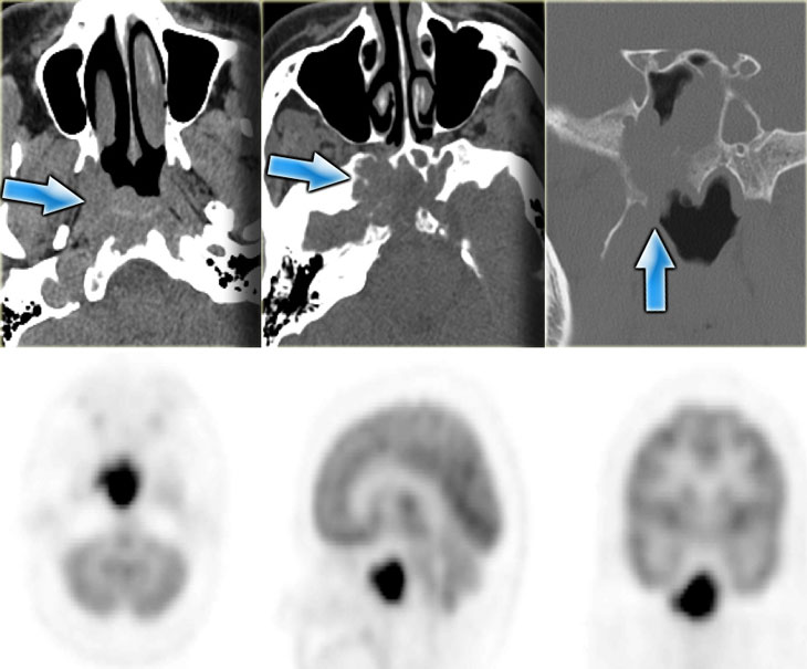 Lymphoma pretreatment