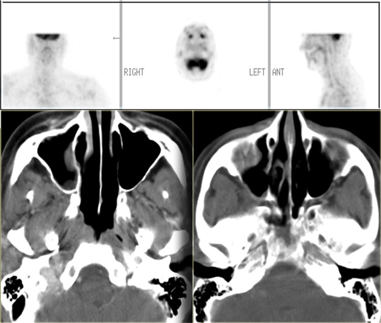 Lymphoma 3 months post-chemoXRT