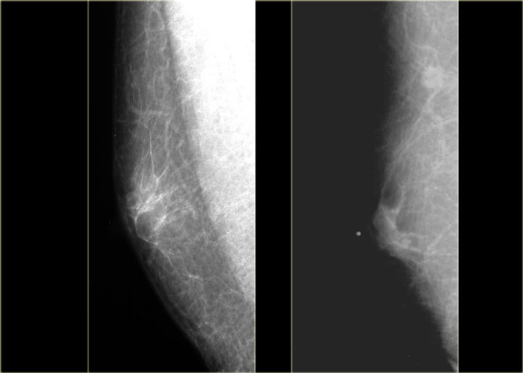 Normal male mammogram Click on image to enlarge