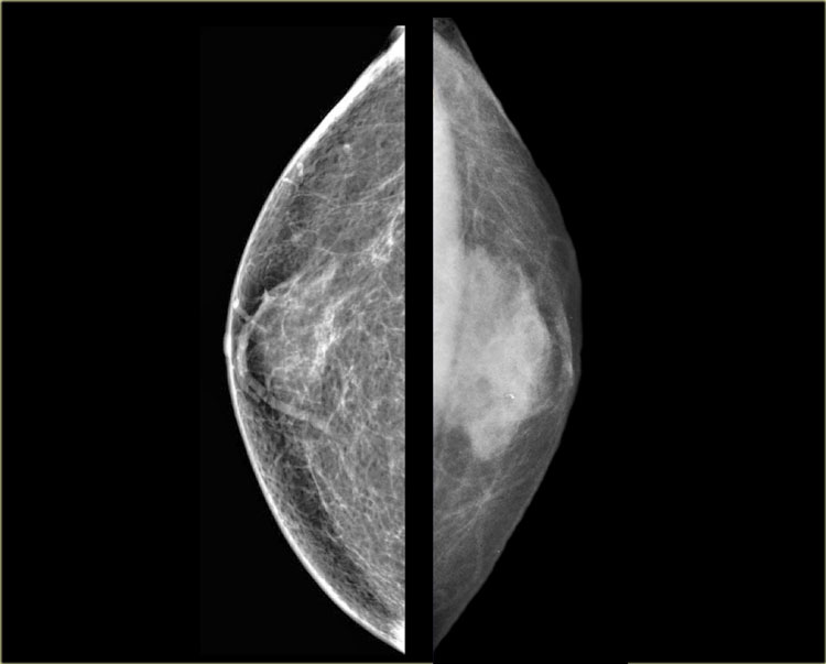 Left: gynecomastia in a young maleRight: Juvenile hypertrophy in an 8 year old female