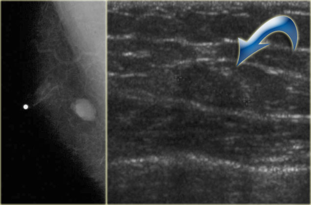 Myofibroblastoma eccentric to the nipple 