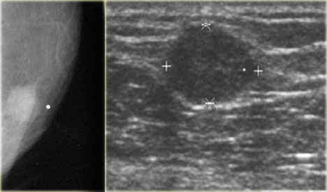 Granular Cell Tumor