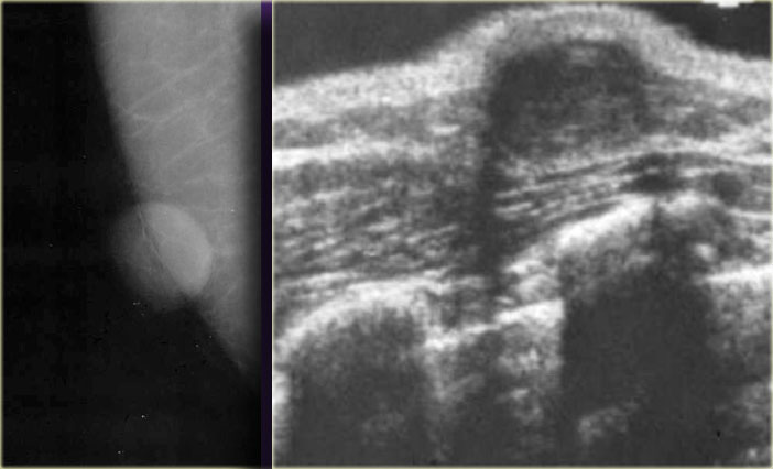 Epidermal inclusion cyst