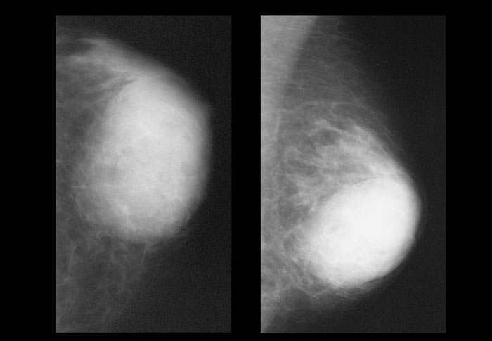 Liposarcoma