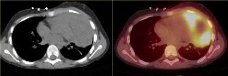 PET-CT of Hodgkin lymphoma