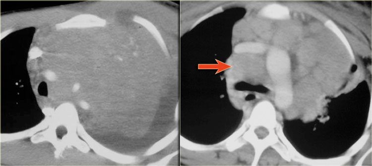 Hodgkin lymphoma