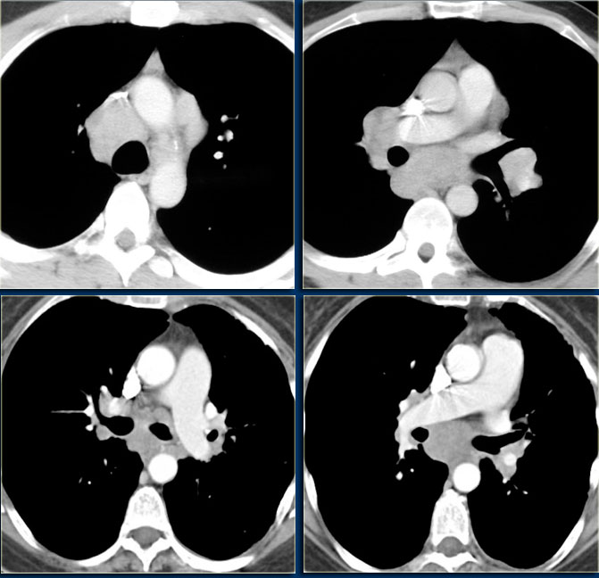 Non-Hodgkin lymphoma