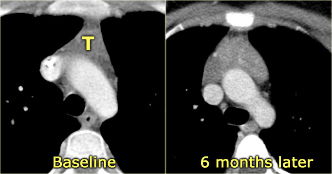 Thymic hyperplasia