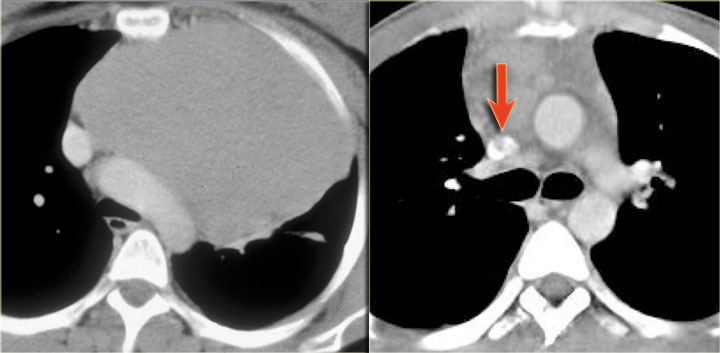 LEFT: Thymoma. RIGHT: Thymic carcinoma.