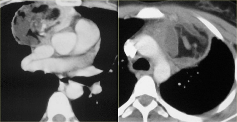 Benign mature teratoma