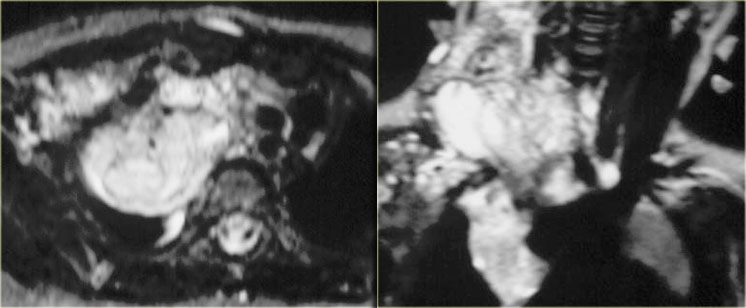 T2 with fatsupression, transversal and coronal