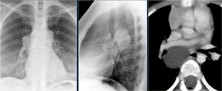 Bronchogenic Cyst