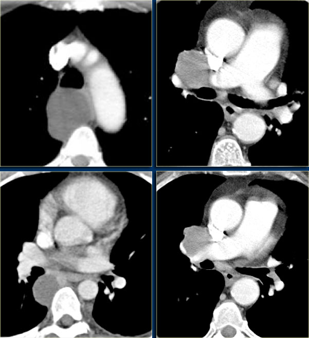 Bronchogenic Cysts