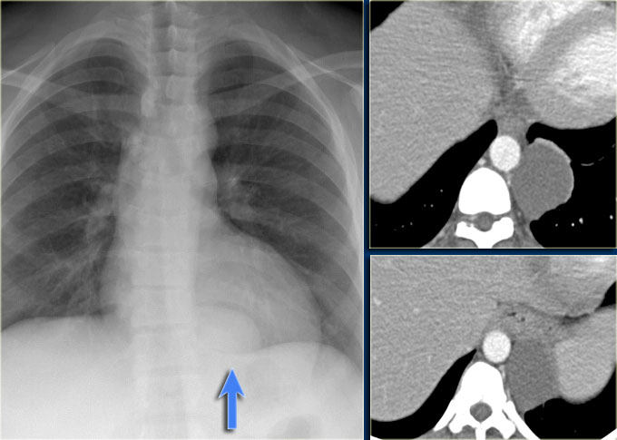 Enteric cyst