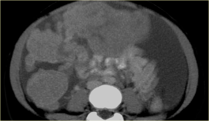 Desmoplastic Small Round Cell Tumor