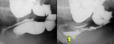 Rectocele seen during straining (right)