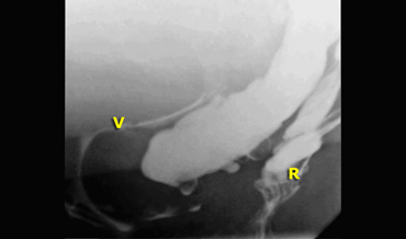 A sigmoidocele is seen between vagina and rectum.