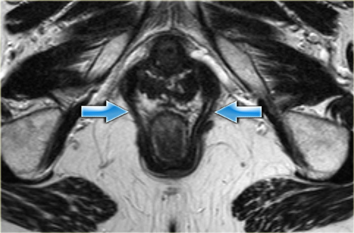 Puborectal muscle forming a 'sling'