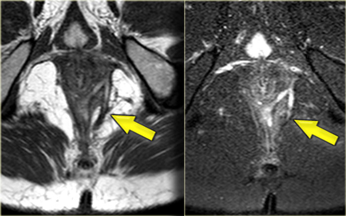 Perianal fistula: axial T2WI without fatsat (left) and with fatsat (right)