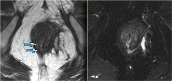 Transsphincteric fistula with sphincter defect at 6 o'clock