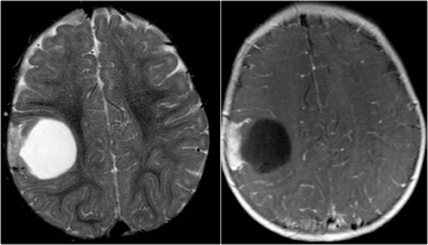 Ganglioglioma. T2WI and CE-T1WI