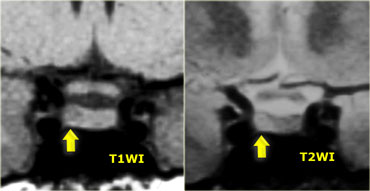 Pituitary Microadenoma