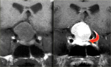 Meningioma. T1WI and T1WI-postcontrast