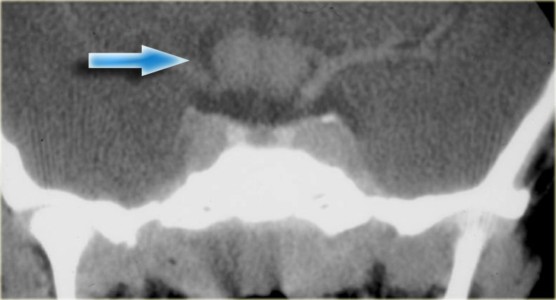 Optic nerve glioma in a patient with neurofibromatosis