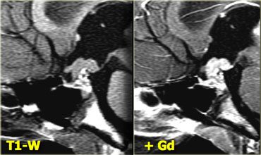 Germinoma (Courtesy of Dr. Susan Blaser)