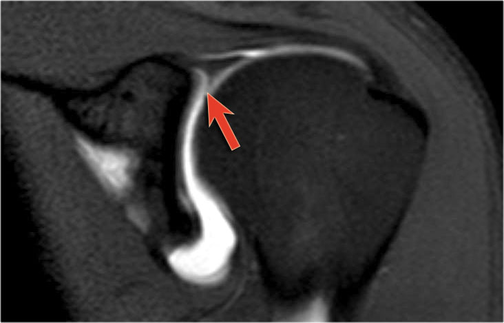 Sublabral recess