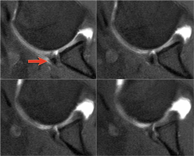 Osseus Bankart on a MR arthrogram ABER-view