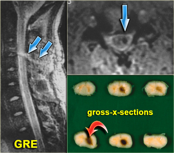 Brown-Sequard Syndrome after stab wound with screwdriver