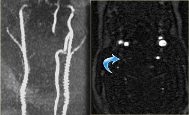 Right vertebral artery thrombosis