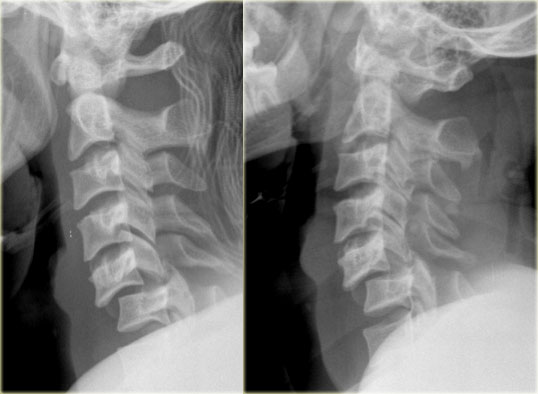 Bilateral interfacetal dislocation